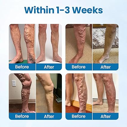 71jkSLzl2JL._SX425_ Varicose Vein Soothing Spray Veins Treatment Spray - Image 6